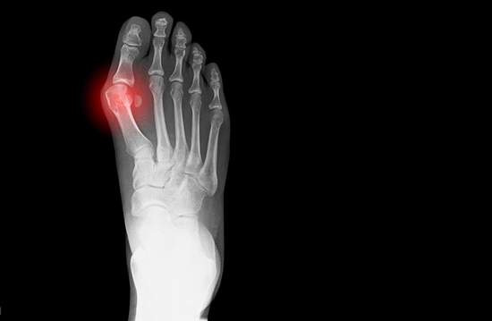 X-ray showing bunion on human foot