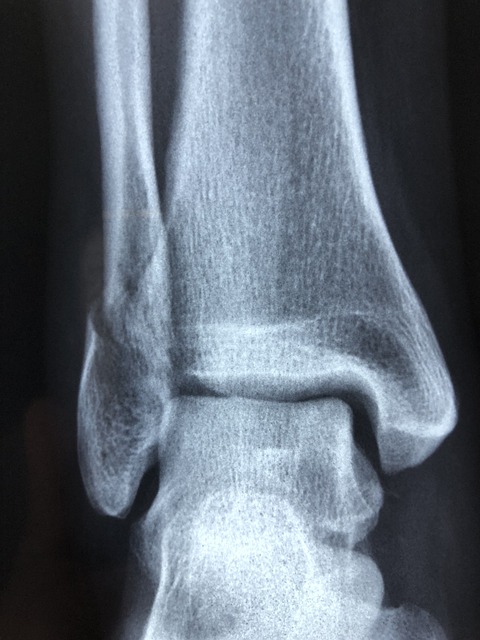 foot and ankle xray